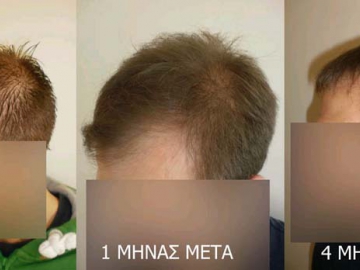 «Νέες θεραπείες  για την τριχόπτωση» 