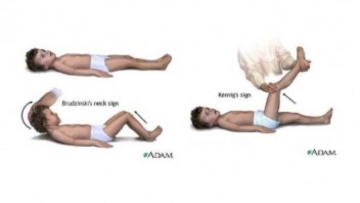 Τι είναι η μηνιγγίτιδα