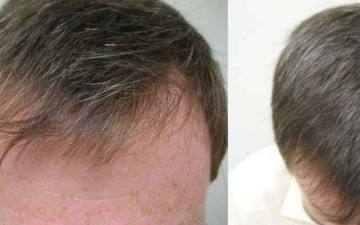 Η μεταμόσχευση μαλλιών στις μέρες μας