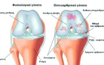 Οστεοαρθρίτιδα και ο ρόλος  της Φυσικοθεραπείας στην αντιμετώπισή της