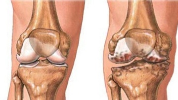 Ενδαρθρική θεραπεία της οστεοαρθρίτιδας γόνατος: Από τα αντιφλεγμονώδη στα προϊόντα της Αναγεννητικής Iατρικής