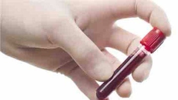 Καρκίνος Μαστού: Τεστ αίματος  προβλέπει την ανταπόκριση στη θεραπεία 