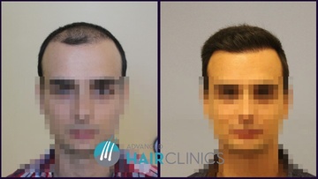 Οι άντρες επενδύουν στα μαλλιά τους  με τη μεταμόσχευση μαλλιών