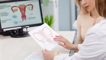 Πολύποδες της μήτρας:  Αίτια, συμπτώματα, θεραπεία