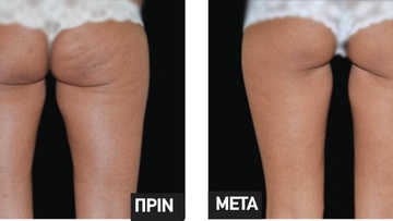 Σύσφιγξη δέρματος με Ραδιοσυχνότητες:  Ιδανική θεραπεία για τη χαλάρωση και την κυτταρίτιδα