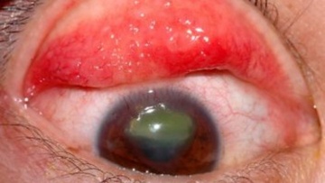 Η πιο σοβαρή αλλεργία των ματιών: Εαρινή (vernal) κερατοεπιπεφυκίτιδα (VKC)