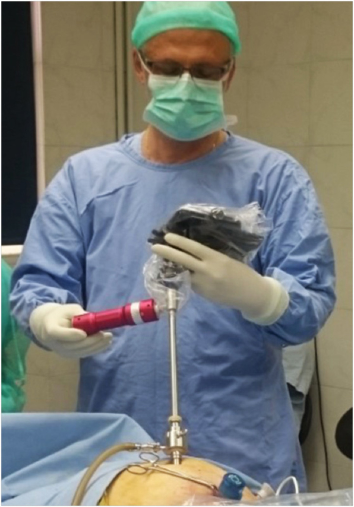 Ο χειρουργός που χειρίζεται το λαπαροσκόπιο βλέπει και καταγράφει εικόνα από το εσωτερικό των οργάνων στο κινητό