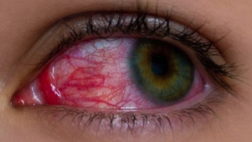 Ραγοειδίτιδα: Αίτια και συμπτώματα της πιο άγνωστης ασθένειας των ματιών