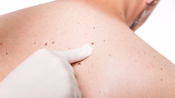 Δέκα μύθοι και αλήθειες για τις ελιές στο δέρμα μας