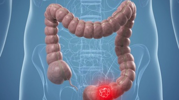 Πρόληψη καρκίνου του παχέος εντέρου