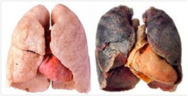 Πνεύμονες μη καπνιστή και καπνιστή. Είναι χαρακτηριστική η διαφορά στο χρώμα που  στη δεύτερη περίπτωση οφείλεται στη συσσώρευση πίσσας