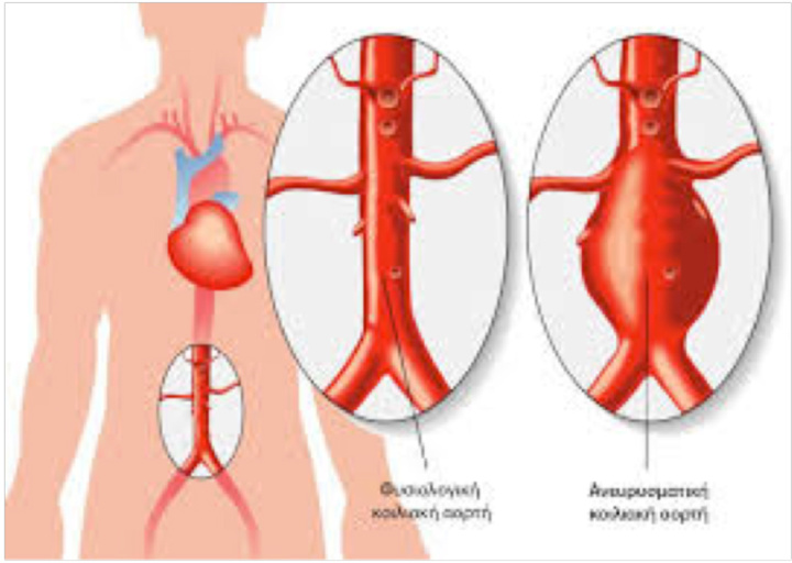 Τα ανευρύσματα στην αορτή όταν ραγούν ( σπάσουν) δημιουργούν μεγάλη κατακλυσμιαία εσωτερική αιμορραγία και απειλούν την ανθρώπινη ζωή