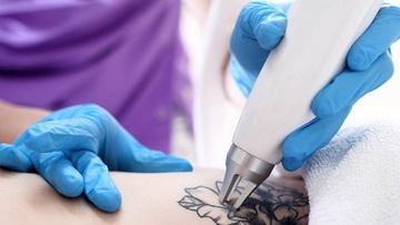 Τατουάζ: Η τεχνική που το σβήνει χωρίς ουλές και δυσχρωμίες