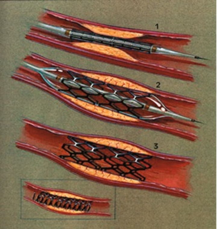 Τα stents διατηρούν ανοιχτή την αρτηρία και ελλαττώνουν το ποσοστό επαναστένωσης των αρτηριών. Όμως μπορεί να θρομβωθούν και να προκαλέσουν έμφραγμα ή αιφνίδιο θάνατο σε ποσοστό 5/1000,  με επακόλουθο ένα νέο έμφραγμα ή ακόμα και αιφνίδιο θάνατο. Γι’ αυτό χρειάζεται παράλληλα να χορηγείται αντιπηκτική θεραπεία