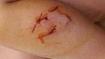 Καταγγελία πατέρα από τη Ρόδο: Σκυλιά επιτέθηκαν και τραυμάτισαν το κορίτσι μου