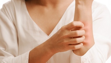 Κοκκινίλες κι εξανθήματα λόγω ζέστης και ιδρώτα: Τι μπορείτε να κάνετε 