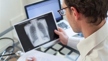 Nέα ευρήματα για τη φυματίωση:  Μεταδίδεται περισσότερο  με την αναπνοή από ό,τι με τον βήχα