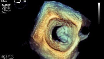 Αντικατάσταση μιτροειδούς βαλβίδας  μέσω μηριαίας φλέβας