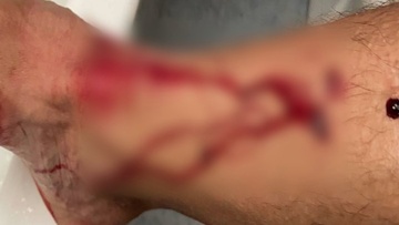 ­Αδέσποτο σκυλί επιτέθηκε και δάγκωσε ποδηλάτη στη Ρόδου-Καλλιθέας