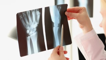 Αρθρίτιδα χεριών: Τι είναι καλύτερο για την αντιμετώπιση του πόνου